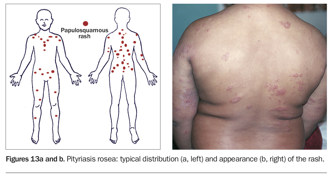 Viral Exanthems Unravelling Viral Rashes Medicine Today